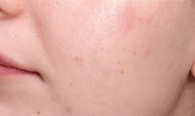 Facial skin after a natural cleansing ritual – smoother appearance and improved texture