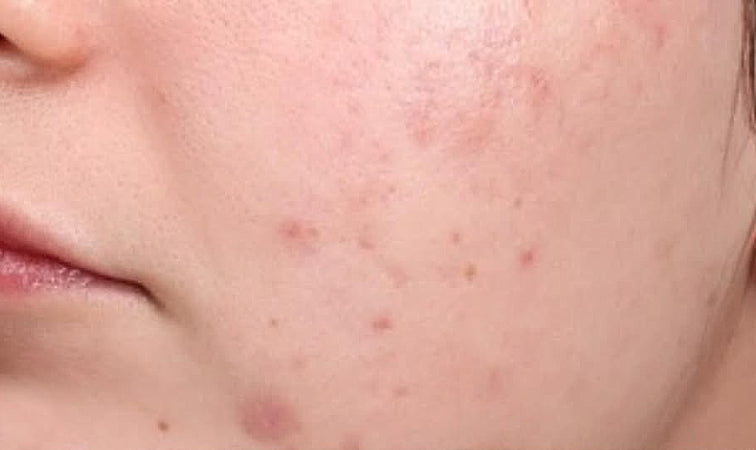 Close-up of facial skin before skincare ritual – visible congestion and uneven tone